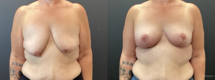 Before & After Breast Lift Case 369 Front View in St. Louis, MO