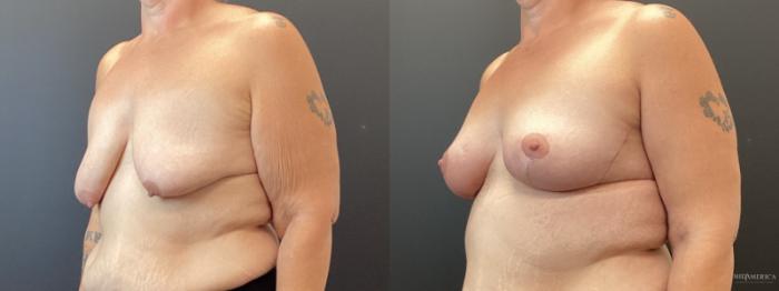 Before & After Breast Lift Case 369 Left Oblique View in St. Louis, MO