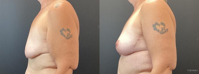 Before & After Breast Lift Case 369 Left Side View in St. Louis, MO