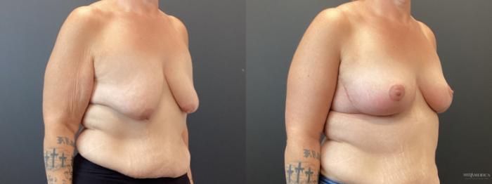 Before & After Breast Lift Case 369 Right Oblique View in St. Louis, MO
