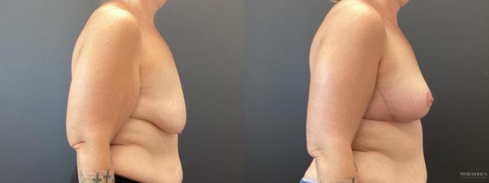 Before & After Breast Lift Case 369 Right Side View in St. Louis, MO