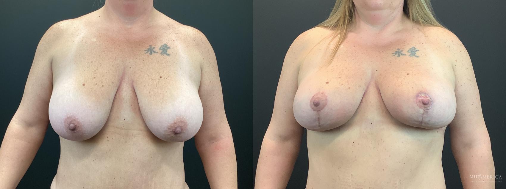 Before & After Breast Lift Case 403 Front View in St. Louis, MO