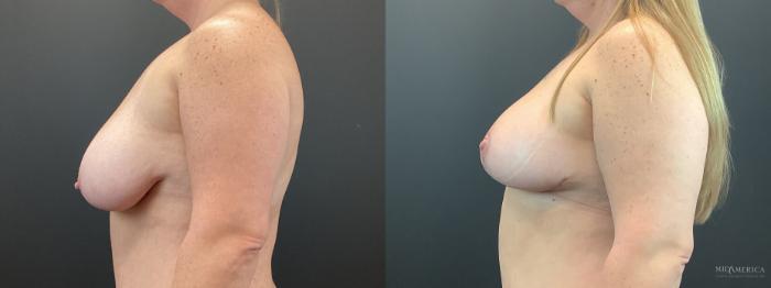 Before & After Breast Lift Case 403 Left Side View in St. Louis, MO