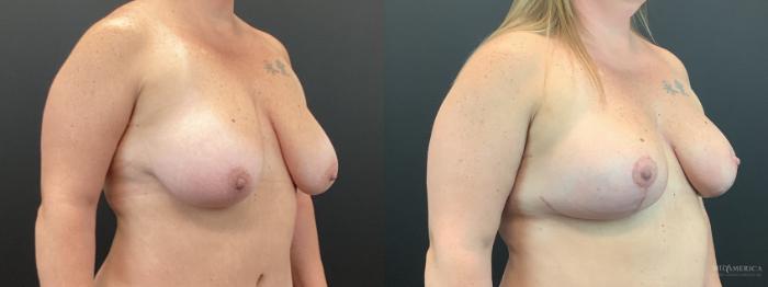 Before & After Breast Lift Case 403 Right Oblique View in St. Louis, MO