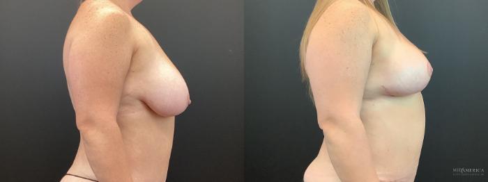 Before & After Breast Lift Case 403 Right Side View in St. Louis, MO