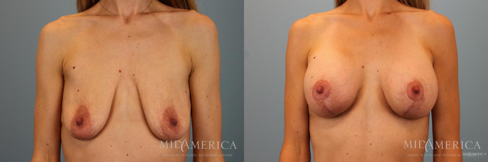 Before & After Breast Lift Case 51 View #1 View in Glen Carbon, IL