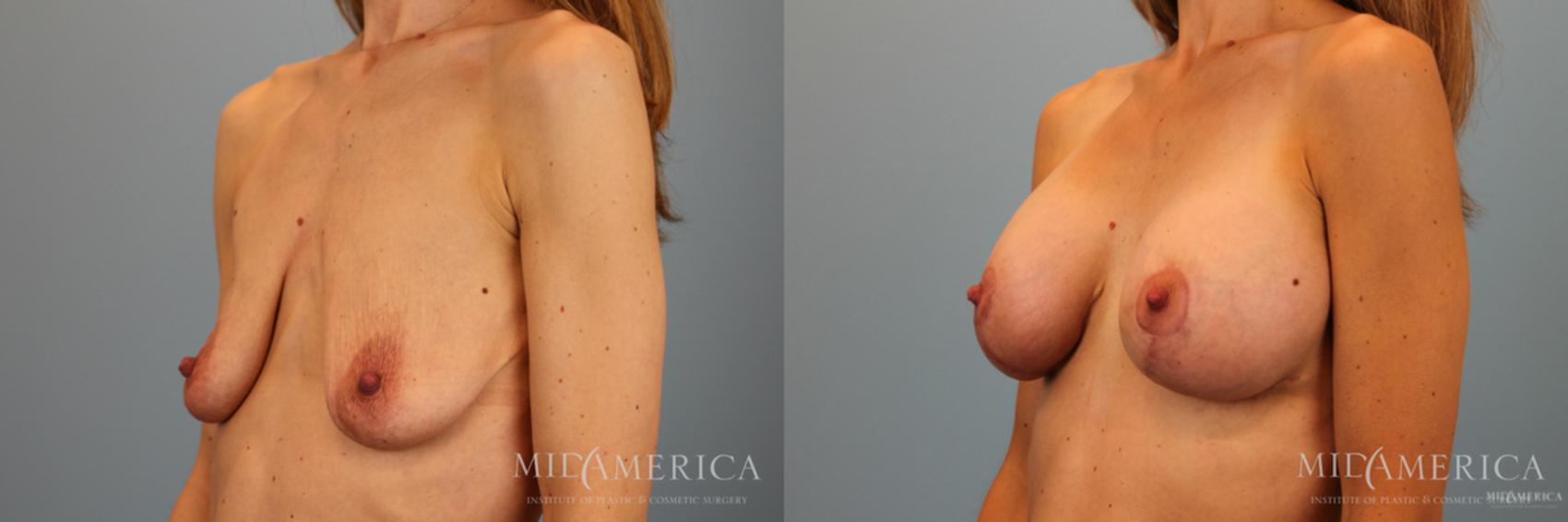 Before & After Breast Lift Case 51 View #2 View in Glen Carbon, IL