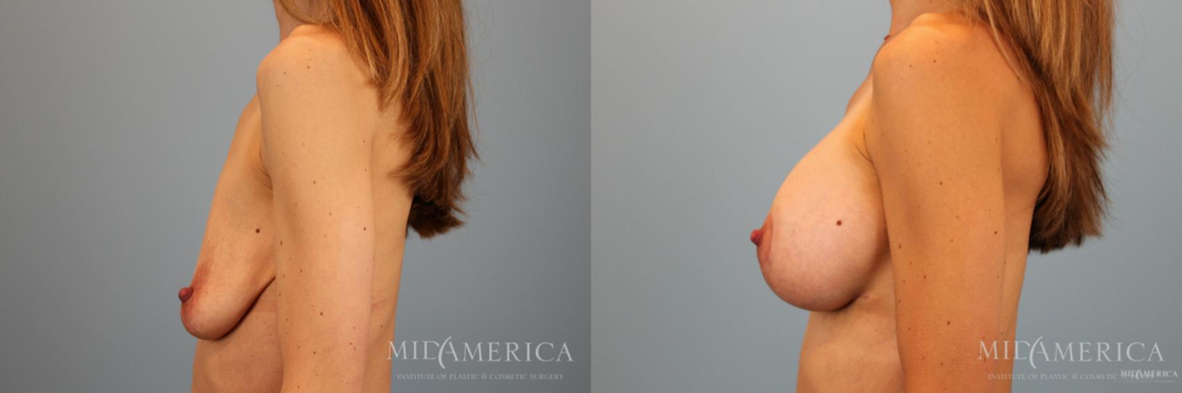 Before & After Breast Lift Case 51 View #3 View in Glen Carbon, IL