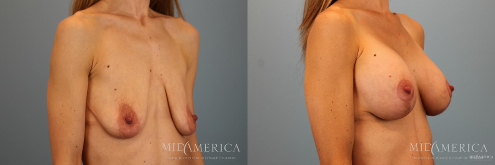 Before & After Breast Lift Case 51 View #4 View in Glen Carbon, IL