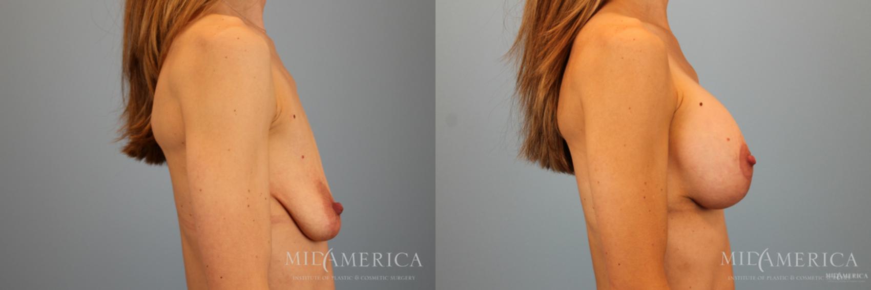 Before & After Breast Lift Case 51 View #5 View in Glen Carbon, IL