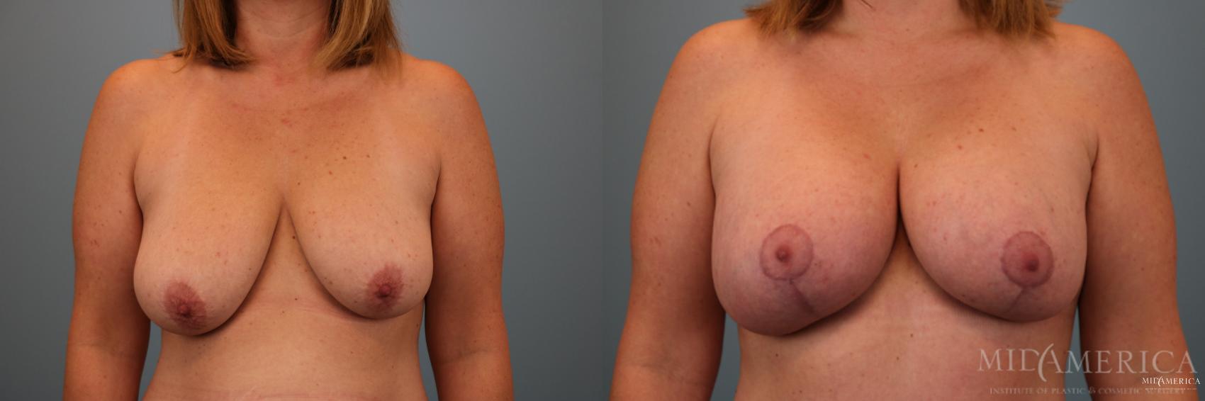 Before & After Breast Lift Case 77 View #1 View in Glen Carbon, IL