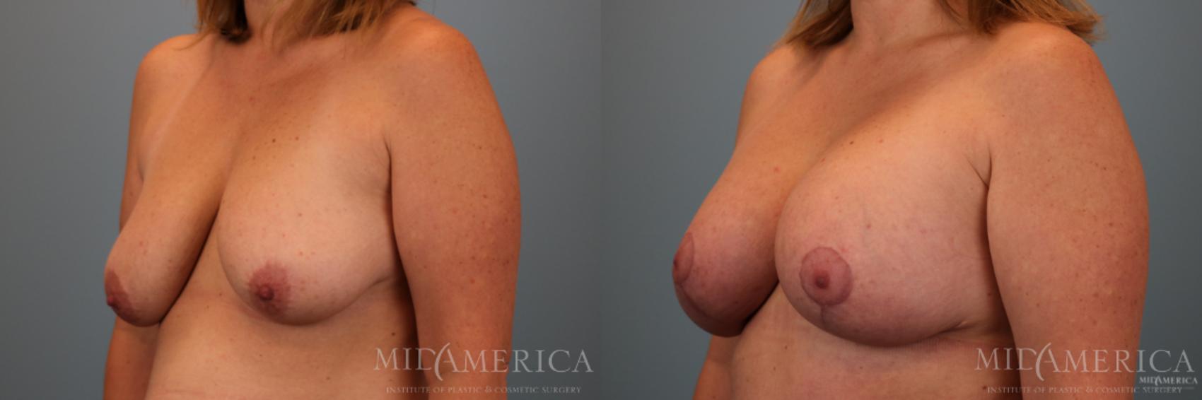 Before & After Breast Lift Case 77 View #2 View in Glen Carbon, IL