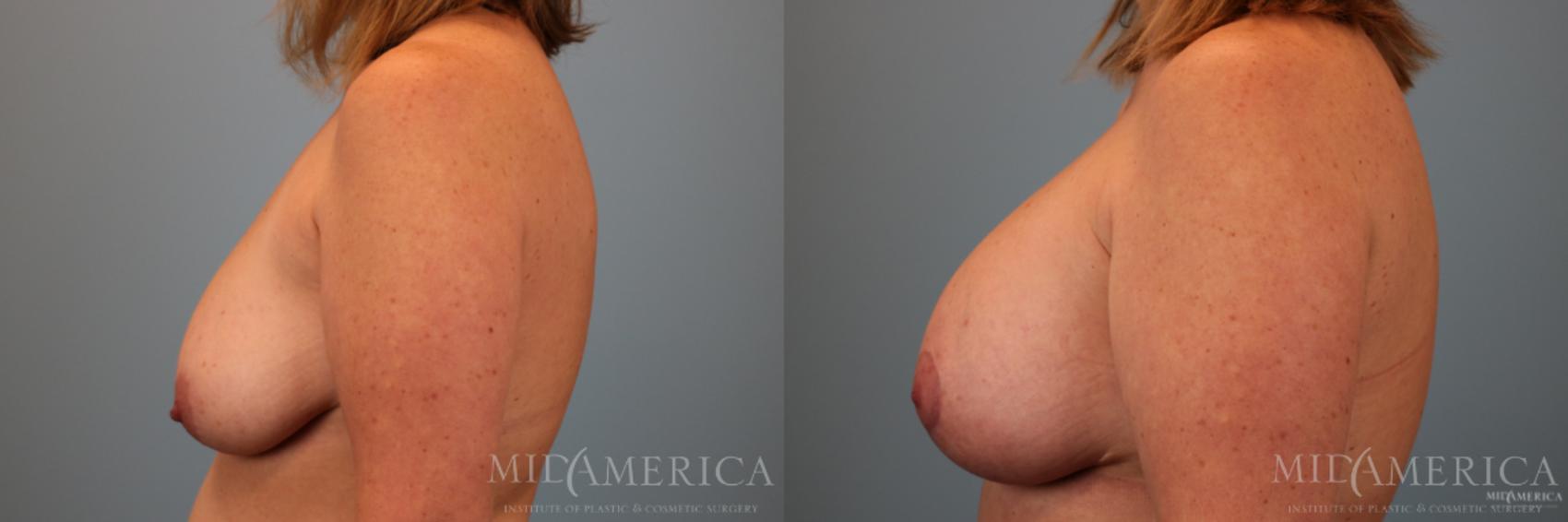 Before & After Breast Lift Case 77 View #3 View in Glen Carbon, IL