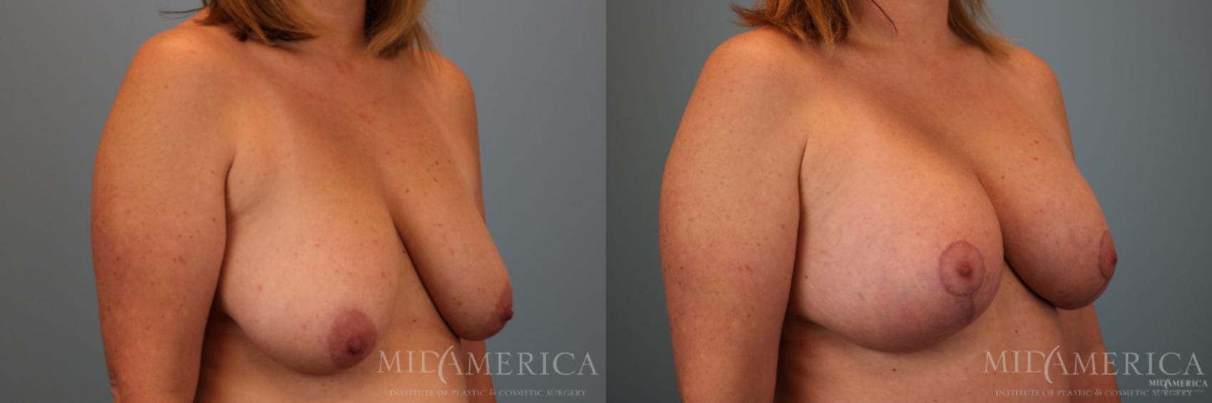 Before & After Breast Lift Case 77 View #4 View in Glen Carbon, IL