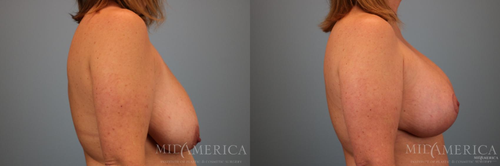 Before & After Breast Lift Case 77 View #5 View in Glen Carbon, IL