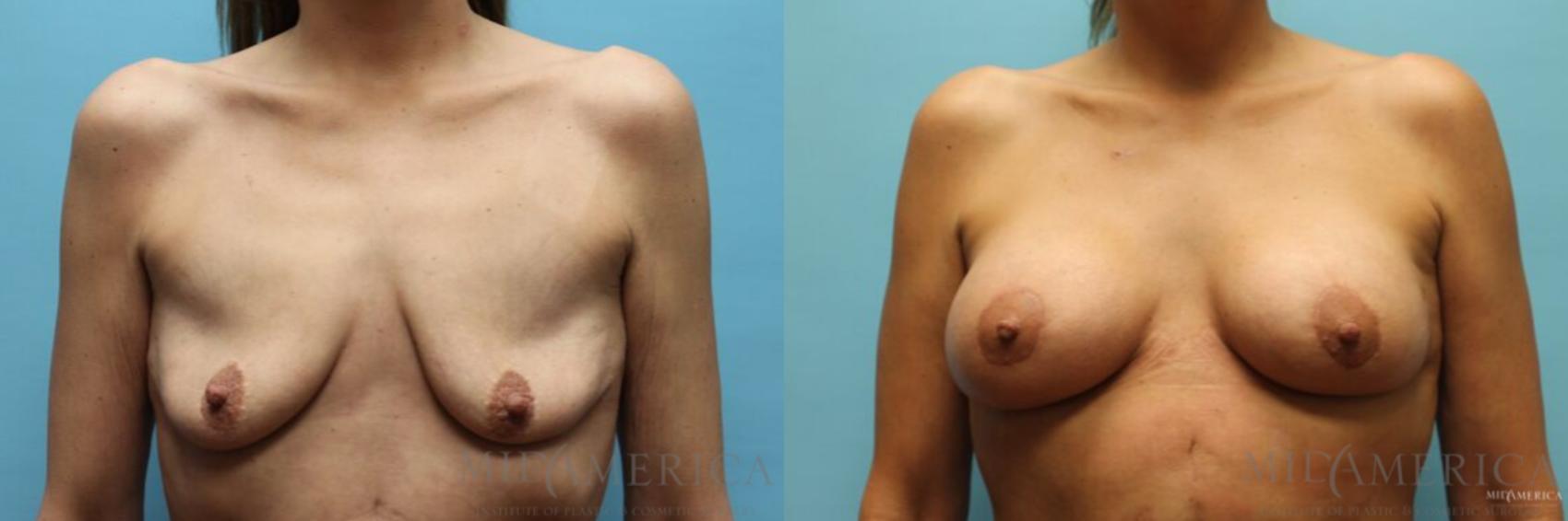 Before & After Breast Lift Case 92 View #1 View in Glen Carbon, IL