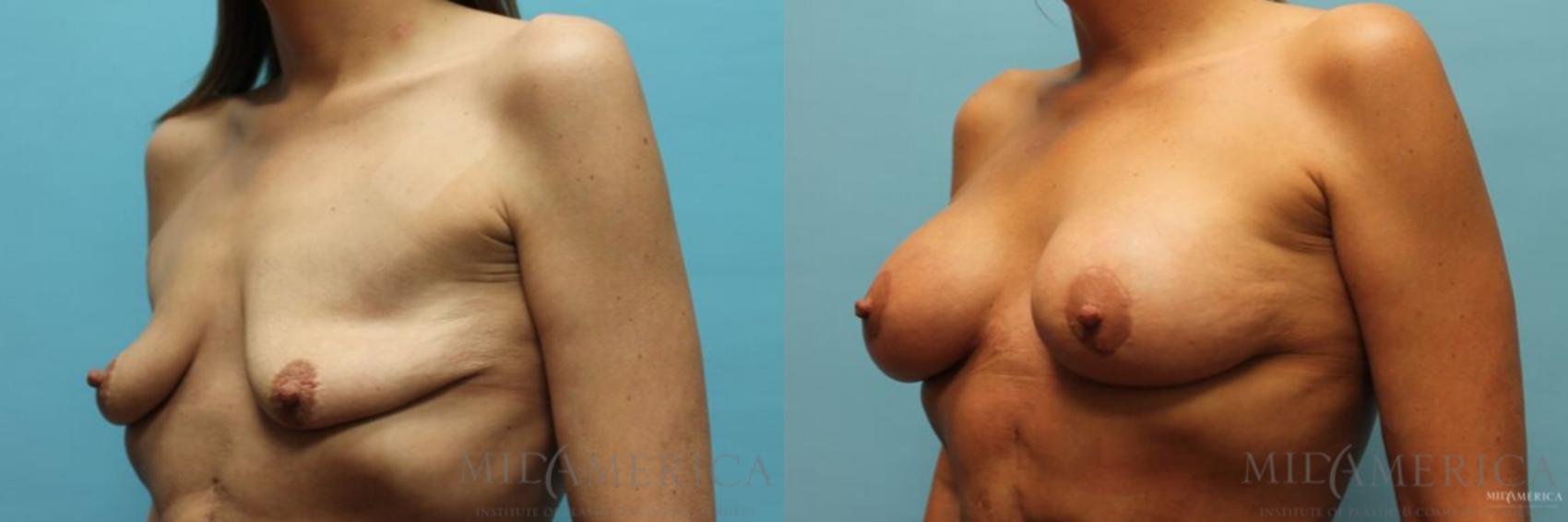 Before & After Breast Lift Case 92 View #2 View in Glen Carbon, IL