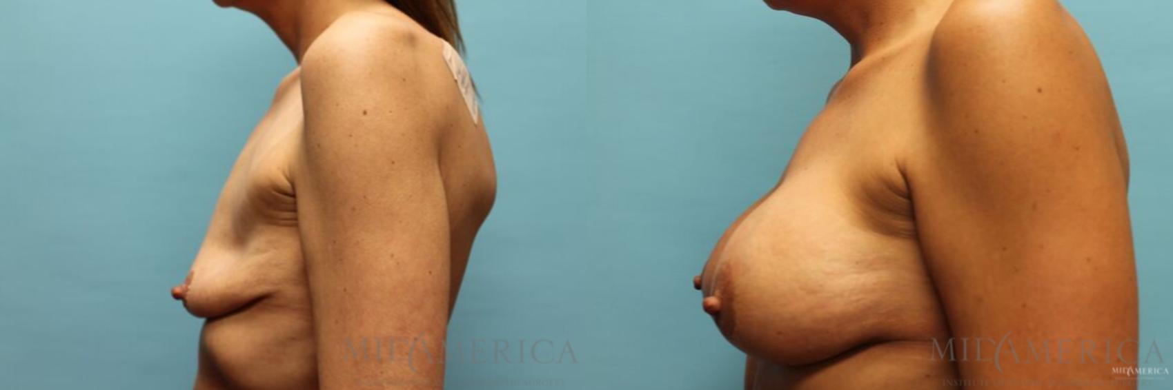 Before & After Breast Lift Case 92 View #3 View in Glen Carbon, IL