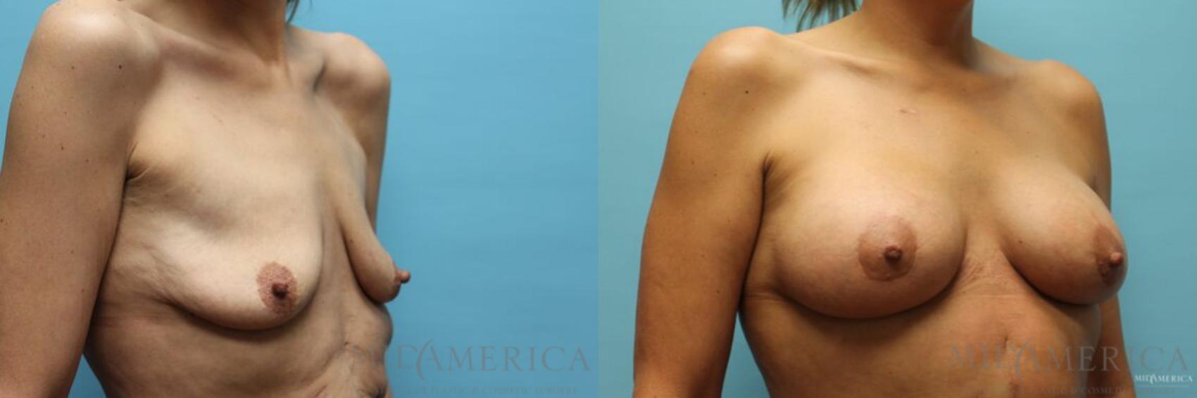 Before & After Breast Lift Case 92 View #4 View in Glen Carbon, IL