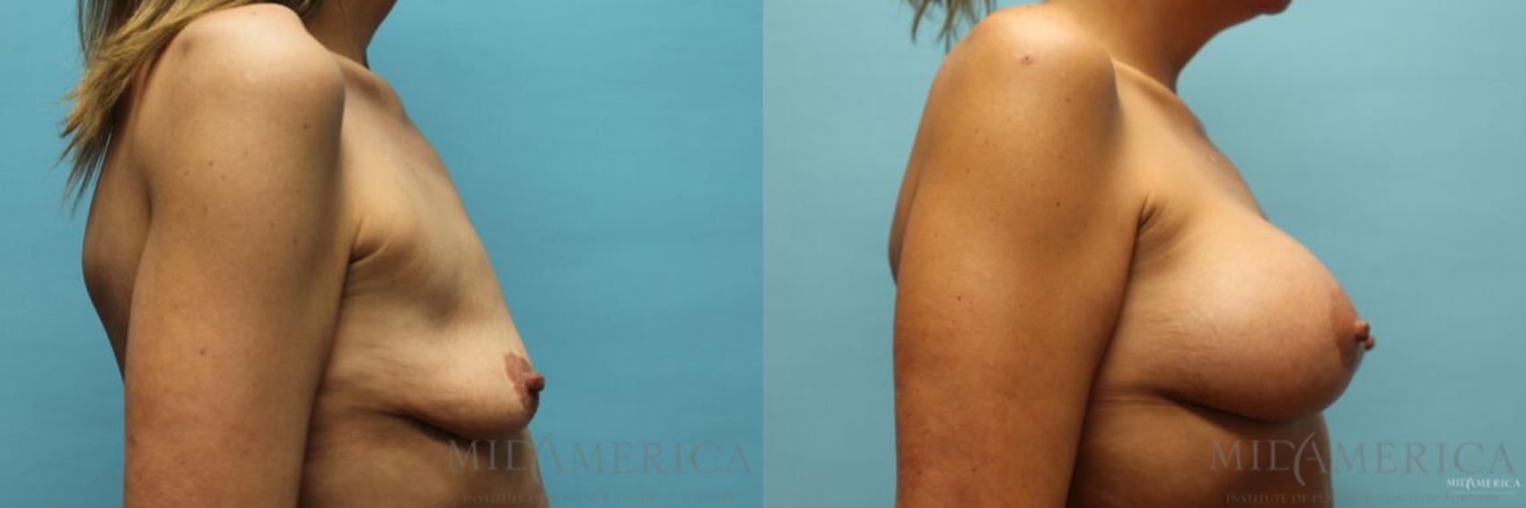 Before & After Breast Lift Case 92 View #5 View in Glen Carbon, IL