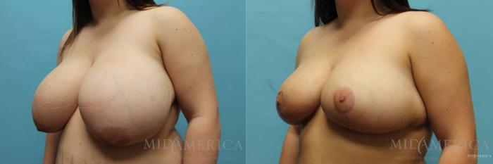 Before & After Breast Reduction Case 107 View #2 View in Glen Carbon, IL