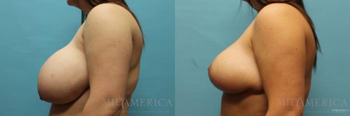 Before & After Breast Reduction Case 107 View #3 View in Glen Carbon, IL