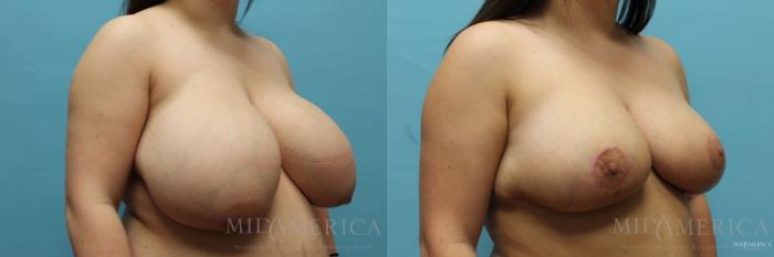 Before & After Breast Reduction Case 107 View #4 View in Glen Carbon, IL