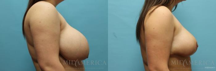 Before & After Breast Reduction Case 107 View #5 View in Glen Carbon, IL
