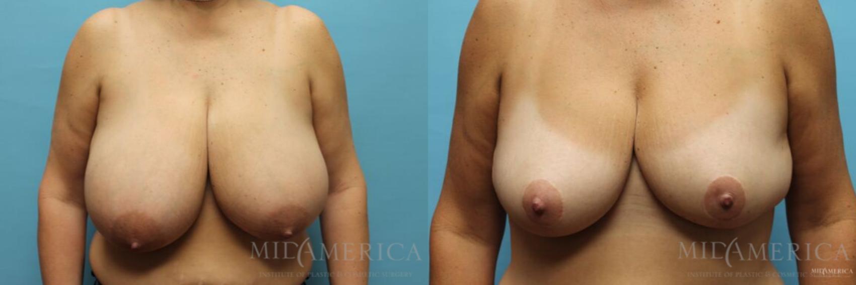 Before & After Breast Reduction Case 112 View #1 View in St. Louis, MO