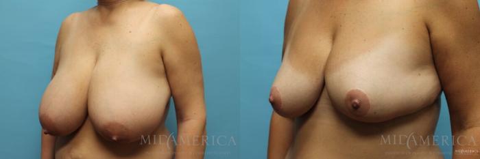 Before & After Breast Reduction Case 112 View #2 View in St. Louis, MO