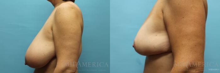 Before & After Breast Reduction Case 112 View #3 View in St. Louis, MO