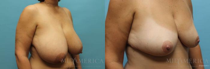 Before & After Breast Reduction Case 112 View #4 View in St. Louis, MO