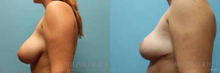 Before & After Breast Reduction Case 113 View #3 View in St. Louis, MO