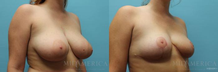 Before & After Breast Reduction Case 113 View #4 View in St. Louis, MO
