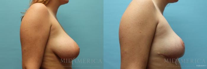 Before & After Breast Reduction Case 113 View #5 View in St. Louis, MO