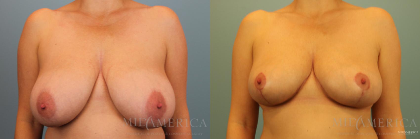 Before & After Breast Reduction Case 136 View #1 View in St. Louis, MO