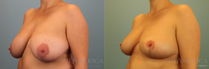 Before & After Breast Reduction Case 136 View #2 View in St. Louis, MO
