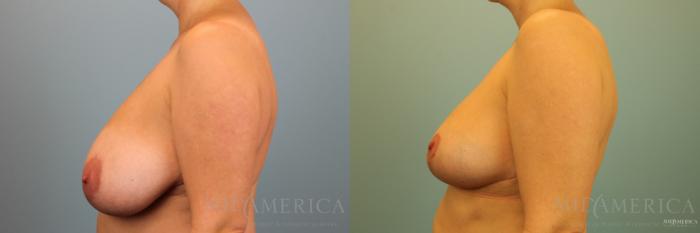 Before & After Breast Reduction Case 136 View #3 View in St. Louis, MO