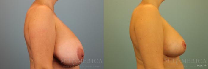 Before & After Breast Reduction Case 136 View #5 View in St. Louis, MO