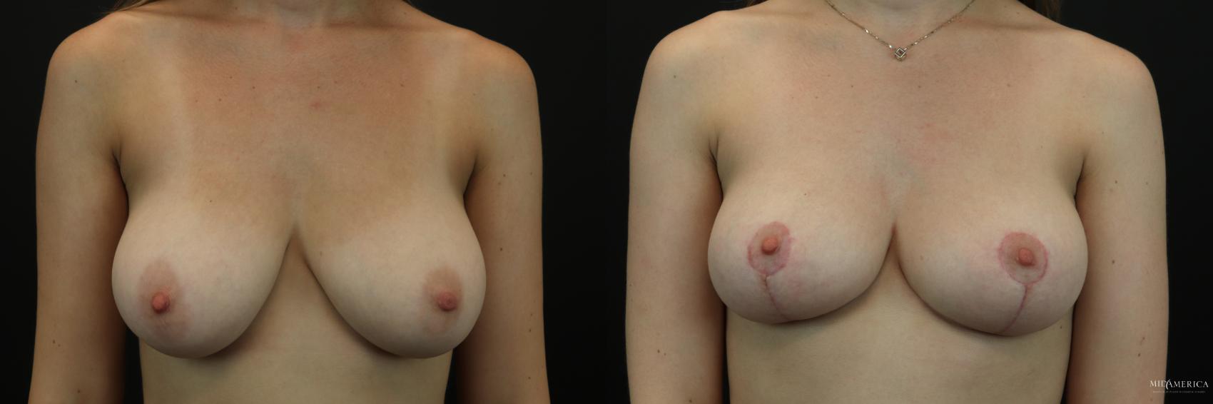 Before & After Breast Reduction Case 208 Front View in Glen Carbon, IL