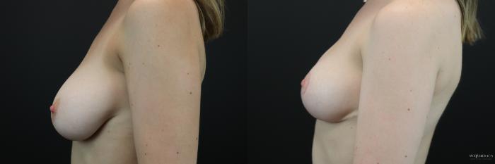 Before & After Breast Reduction Case 208 Left Side View in Glen Carbon, IL
