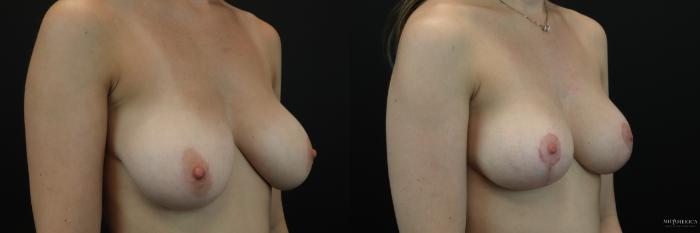 Before & After Breast Reduction Case 208 Right Oblique View in Glen Carbon, IL