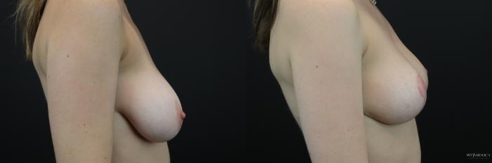 Before & After Breast Reduction Case 208 Right Side View in Glen Carbon, IL