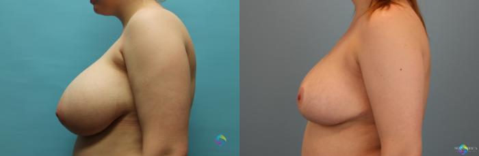 Before & After Breast Reduction Case 21 View #2 View in St. Louis, MO