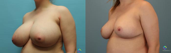 Before & After Breast Reduction Case 21 View #3 View in St. Louis, MO