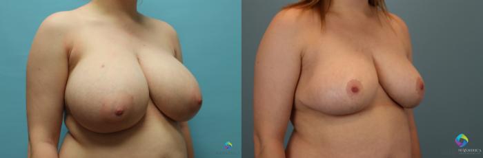 Before & After Breast Reduction Case 21 View #4 View in St. Louis, MO