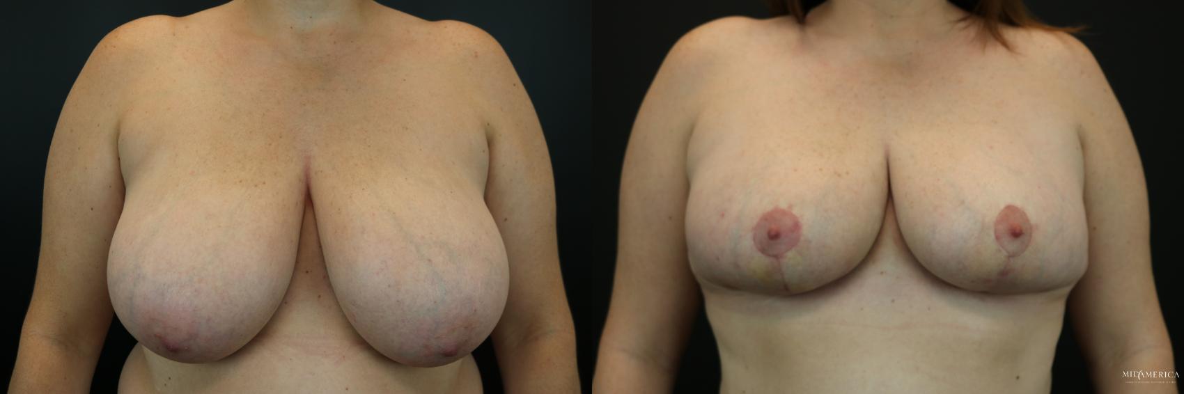 Before & After Breast Reduction Case 216 Front View in St. Louis, MO