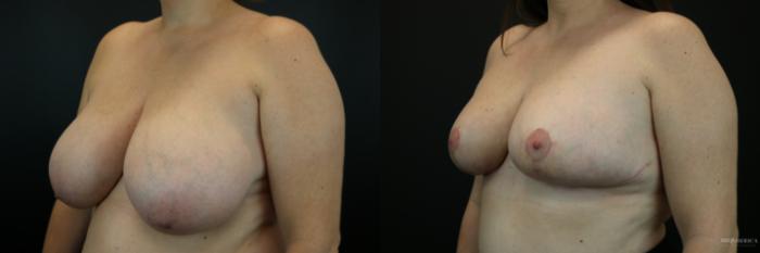 Before & After Breast Reduction Case 216 Left Oblique View in St. Louis, MO