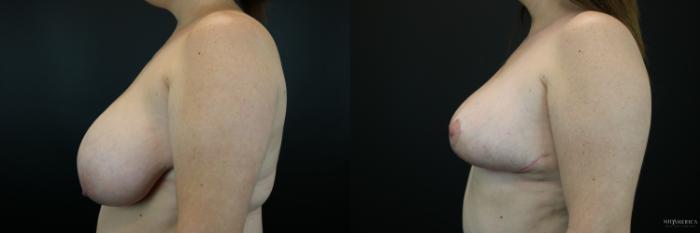 Before & After Breast Reduction Case 216 Left Side View in St. Louis, MO