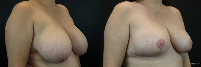 Before & After Breast Reduction Case 216 Right Oblique View in St. Louis, MO